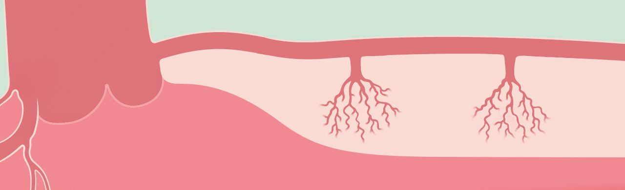 microvascular-dysfunction_rest.gif