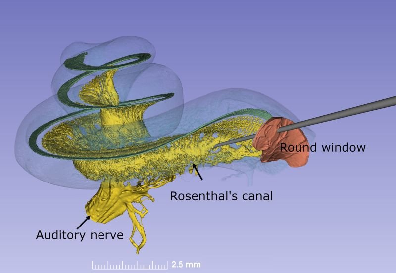 3d-Cochlear-and-needle.jpg
