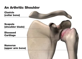 arthritic_shoulder_w.jpg
