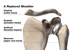 replaced_shoulder_w.jpg