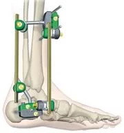 foot_ankle_ext1.jpg