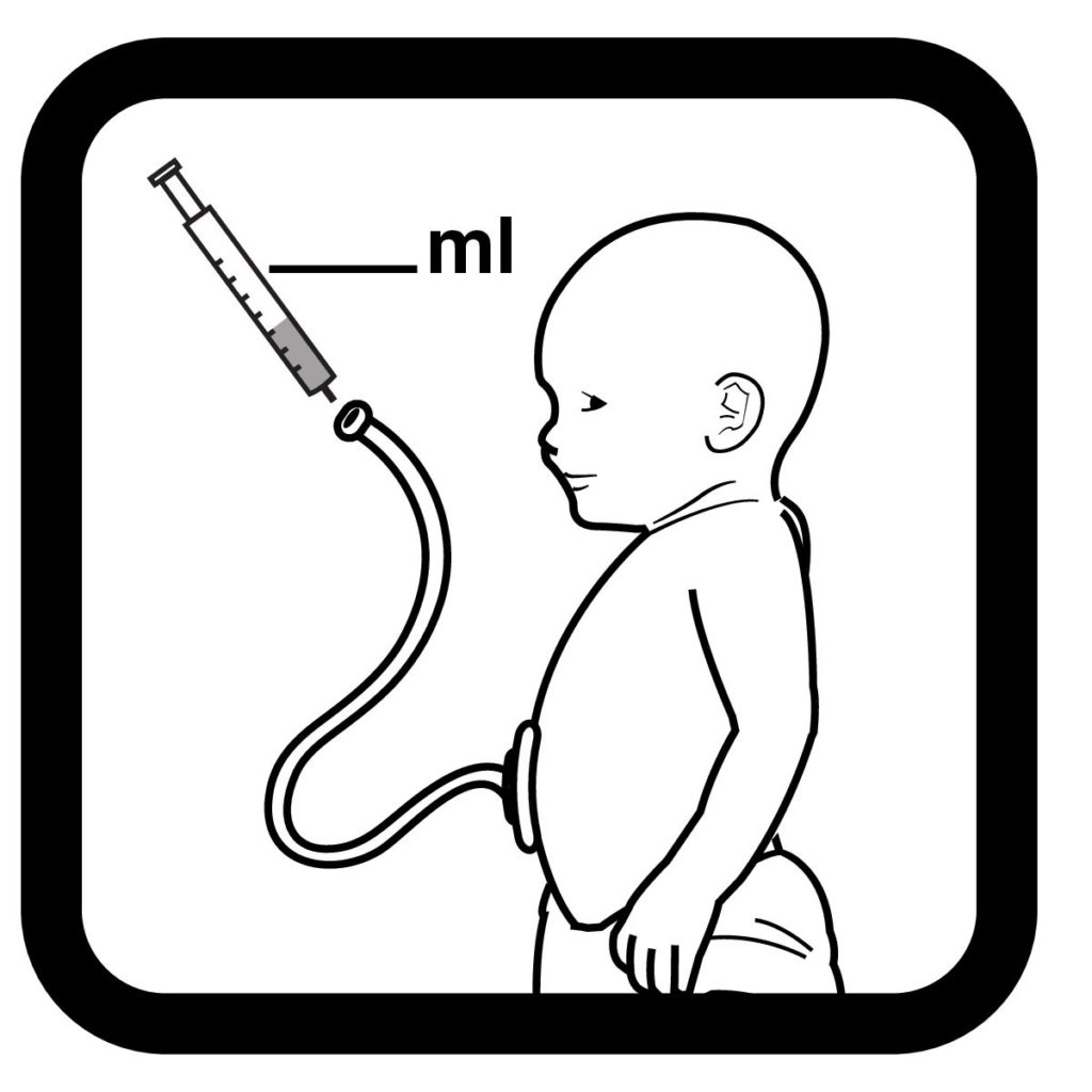 Via-gastric-Tube-Infant-1024x1024.jpg