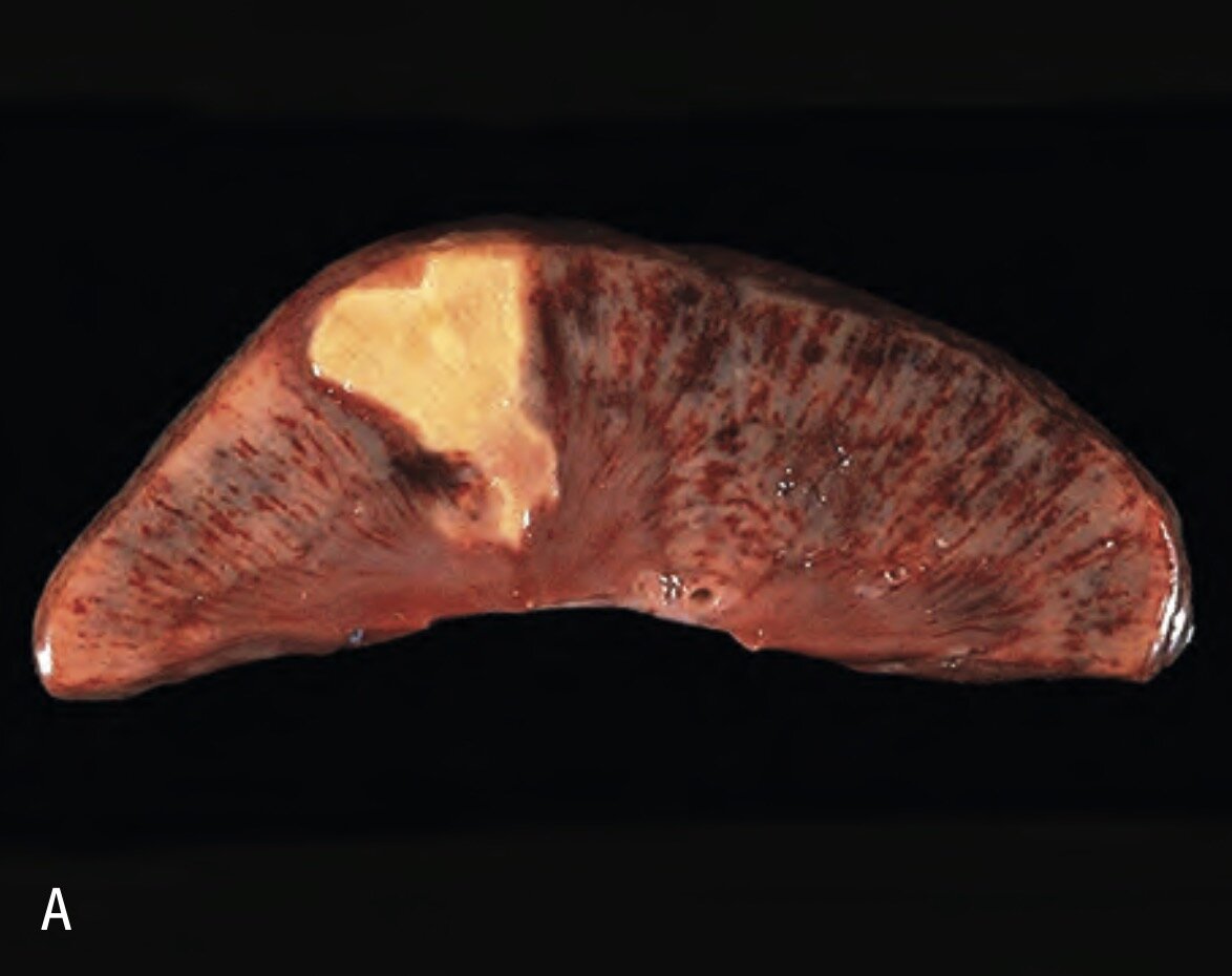 The Different Types of Necrosis and Their Histological Identifications