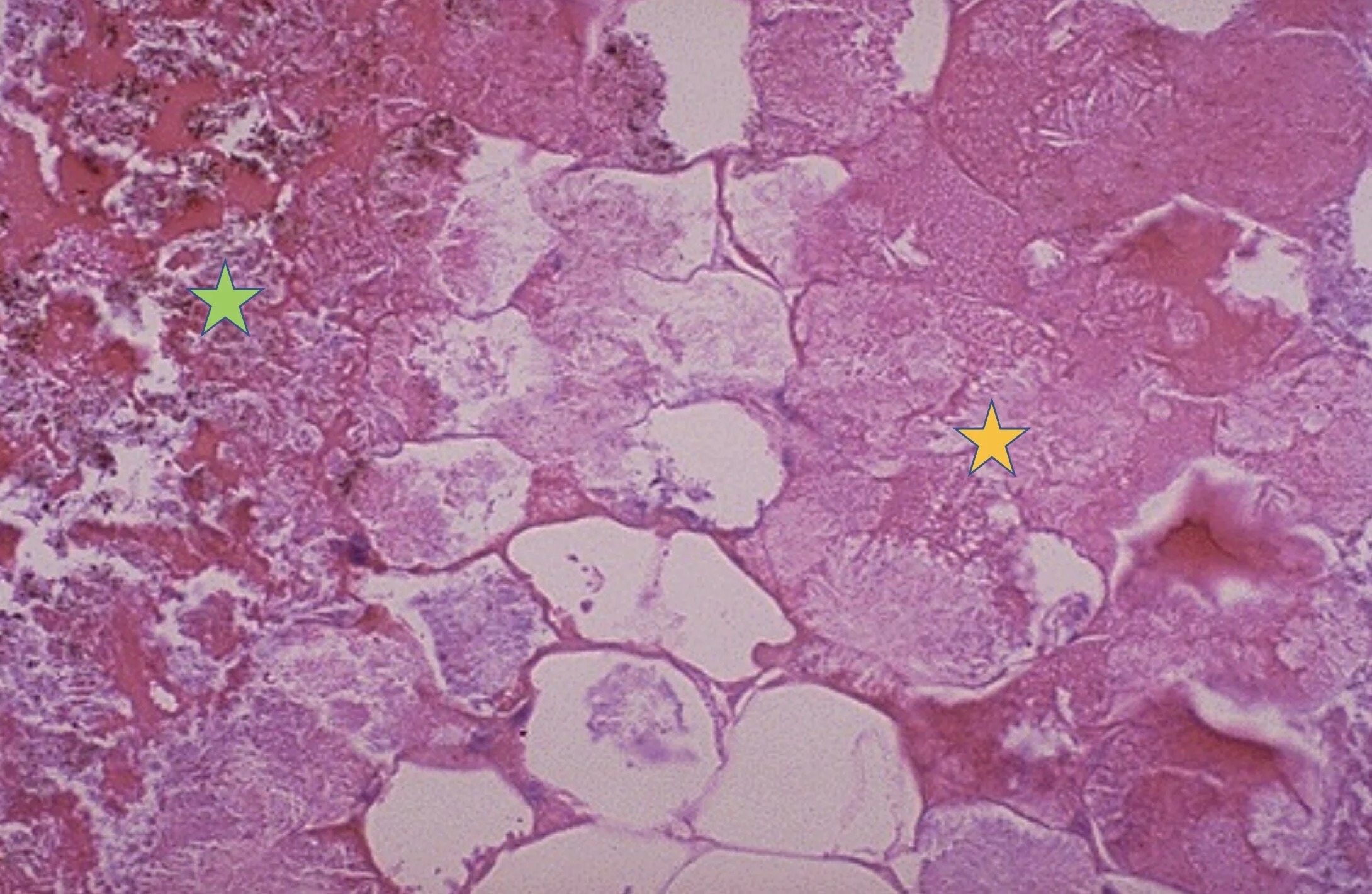The Different Types of Necrosis and Their Histological Identifications. — Andréas Astier