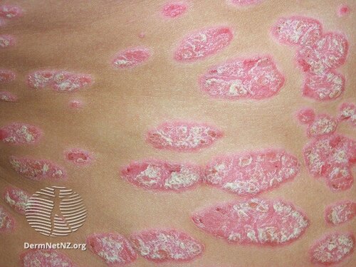 dermnet psoriasis guttate