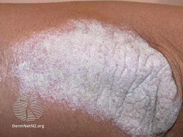 psoriasis derm net