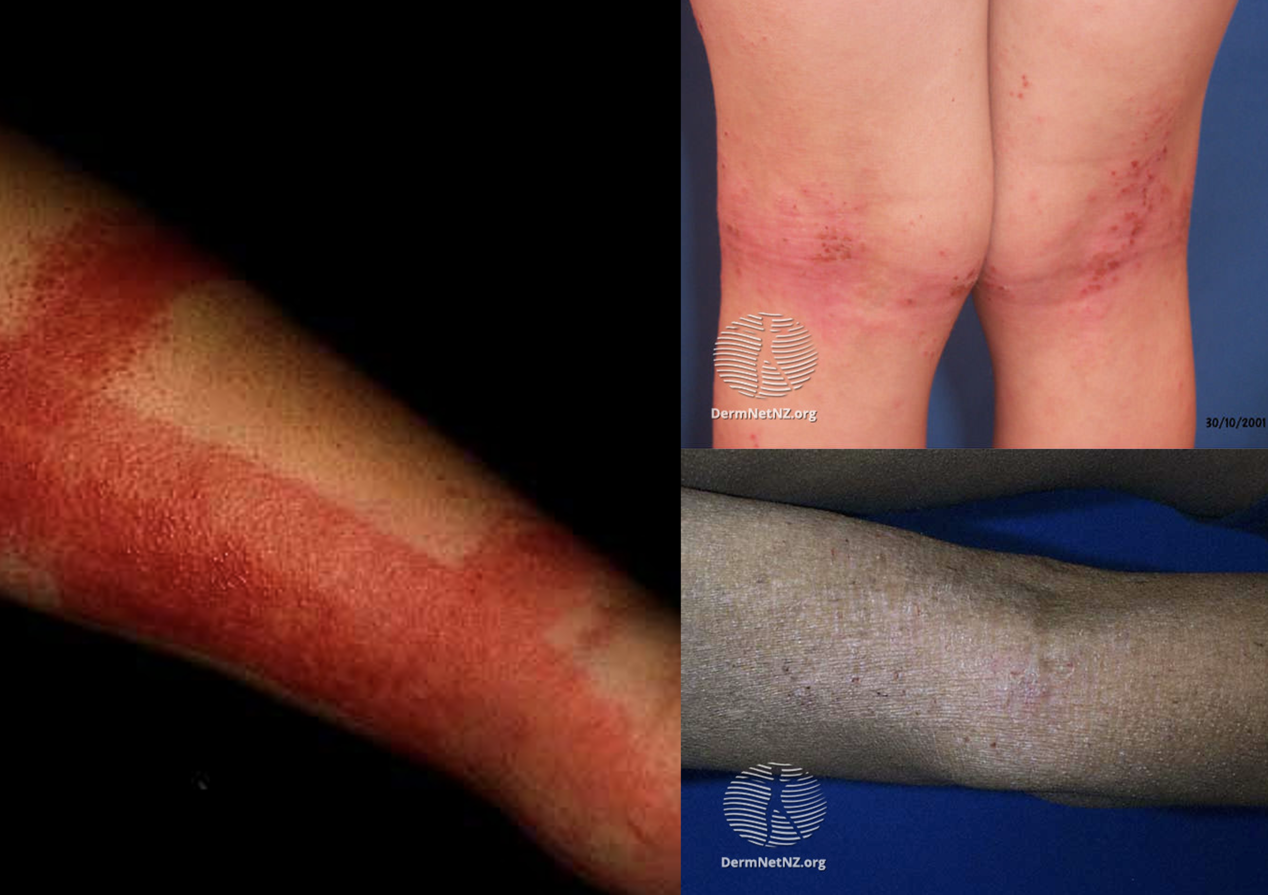 The Skin Condition That Affects 1 in 5 People — Dermatitis.