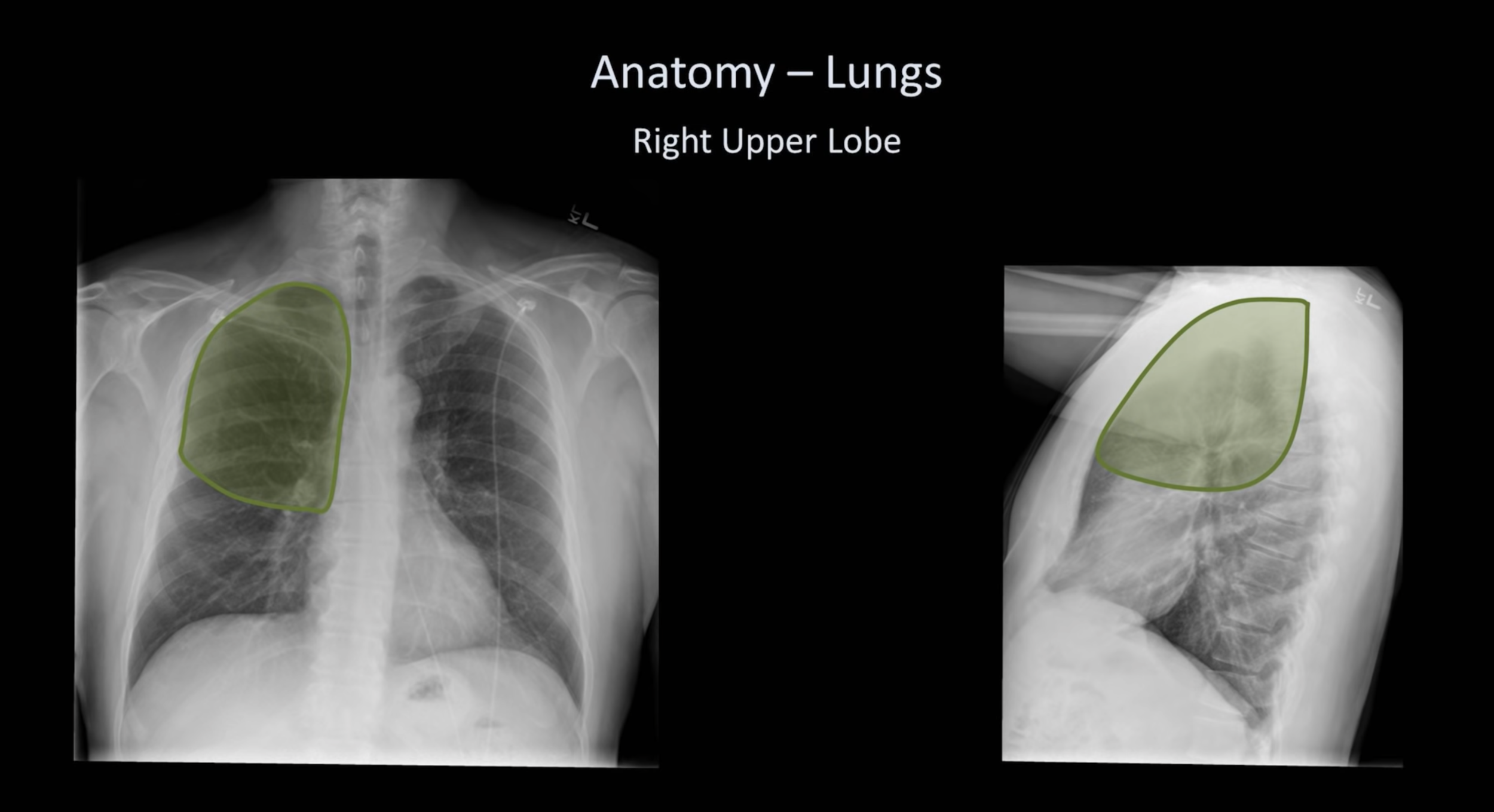 normal chest xray labeled