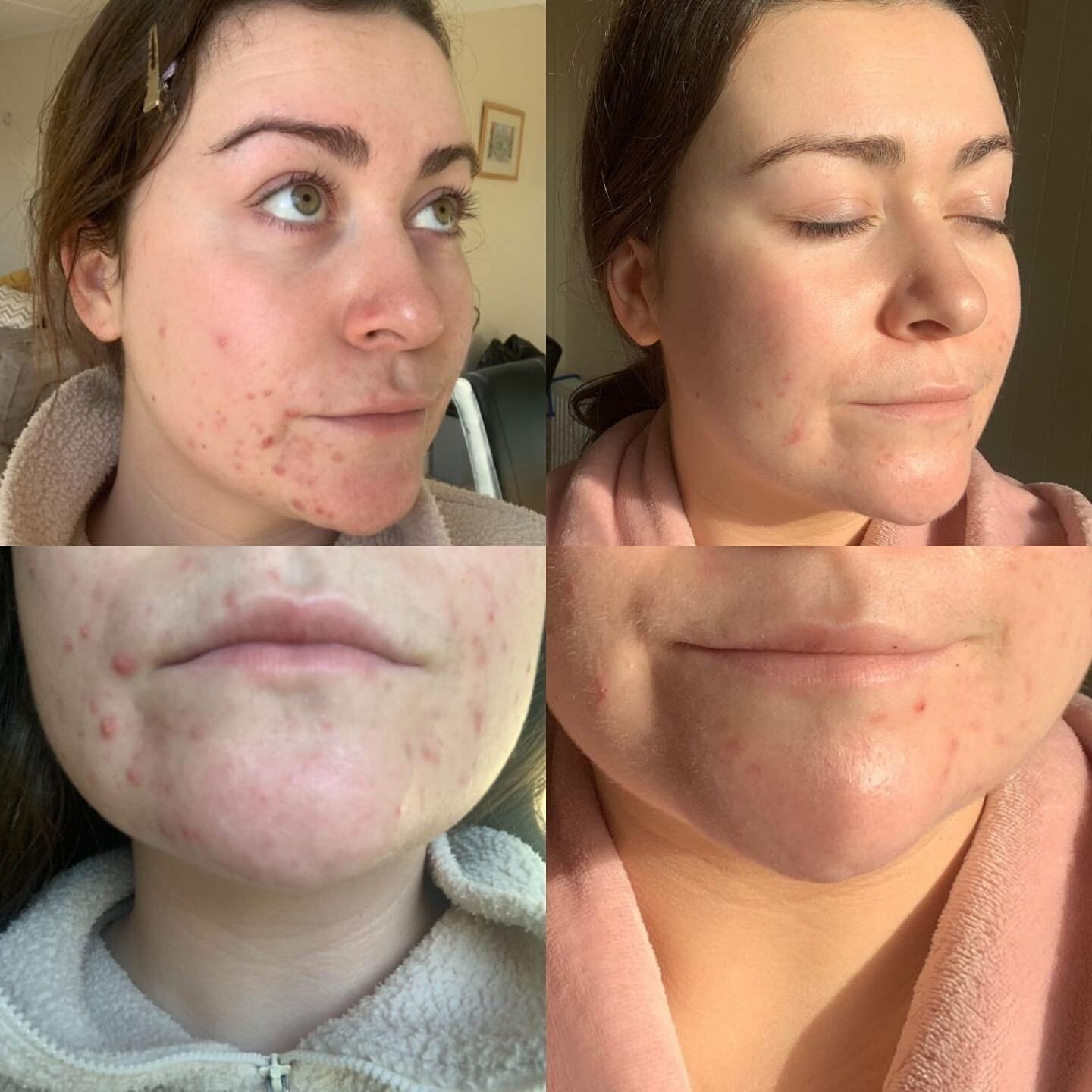 &bull; Sally &bull; 

&ldquo;The difference in my skin since following your recommendations! I&rsquo;m so happy, I never felt confident without makeup before.&rdquo;

These photos are taken 2 months apart. The lighting is at different times of the da