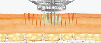 Effects of Electroporation: Maximizes the drug absorption of cells