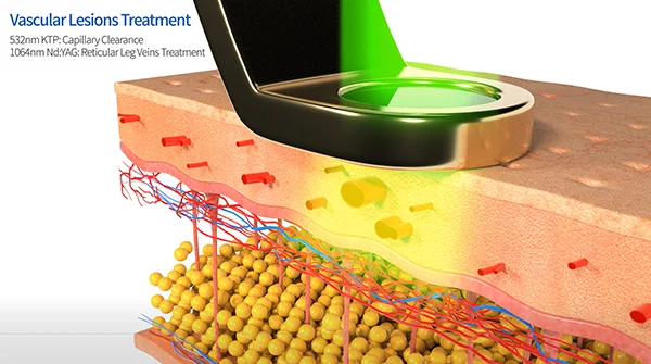v-laser_vascular(0).jpg