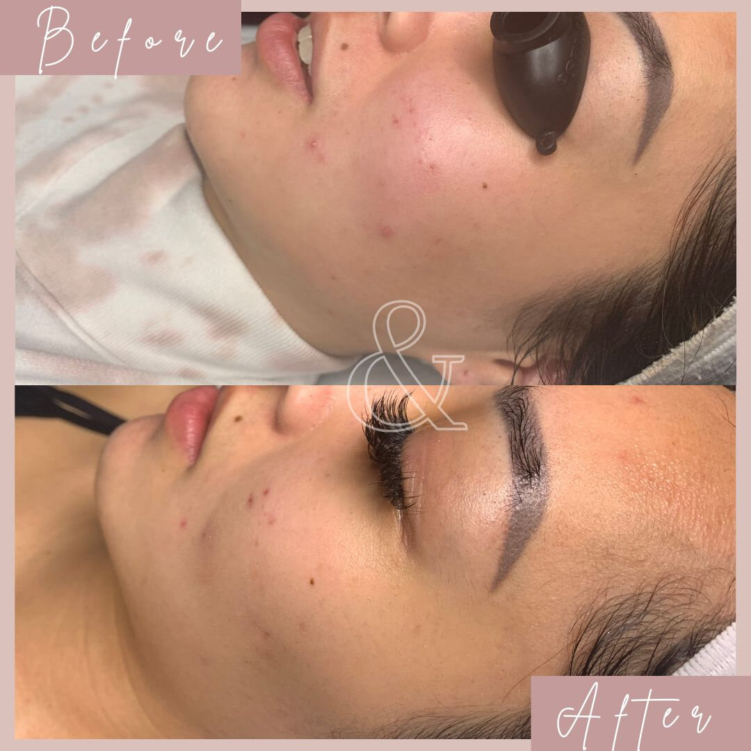 Who doesn't love a good before and after? As you can see with this client we have worked on active breakouts, discoloration and even the redness in her skin has gone down. ​​​​​​​​
​​​​​​​​
Leave it to good skincare and monthly facials for overall sk