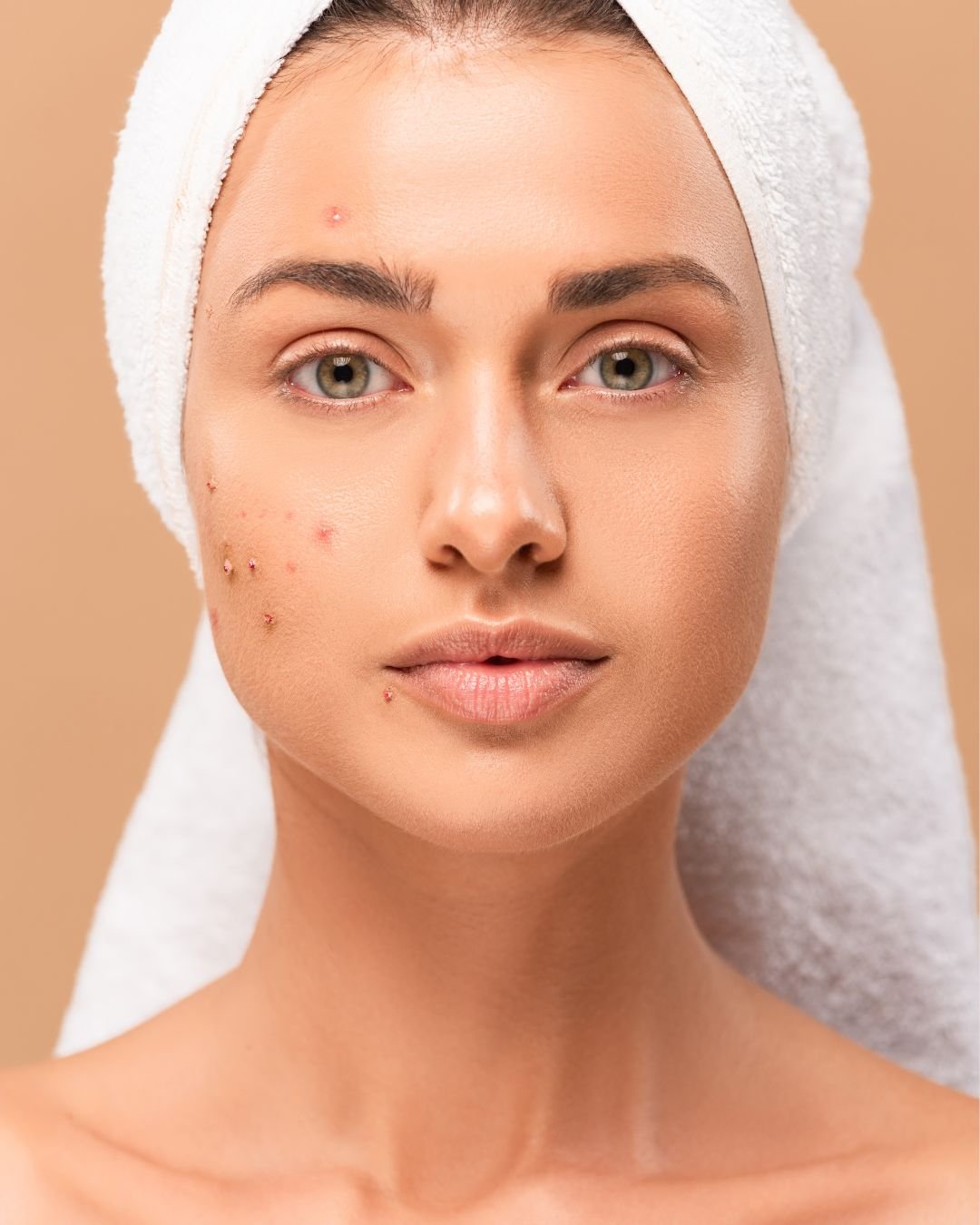 Get Clear Skin Once And For All!!