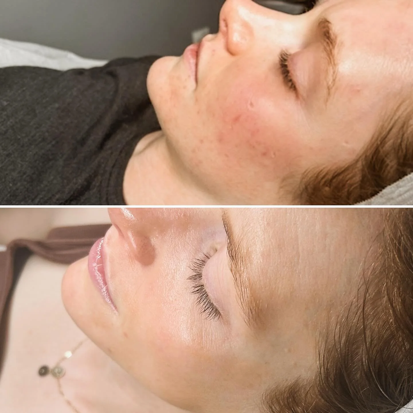 ✨ From breakouts to bare-faced confidence✨

This isn&rsquo;t just &ldquo;good lighting&rdquo; &mdash; it&rsquo;s months of consistency, healthy skin habits, and professional care coming together. 💪

You want to know the biggest success to her result