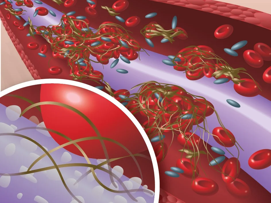 technology - thrombosis.jpg