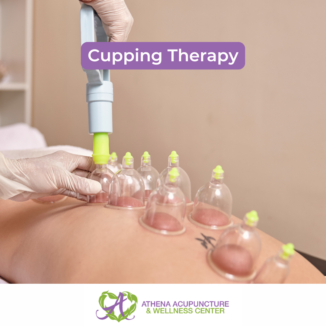 Cupping Therapy