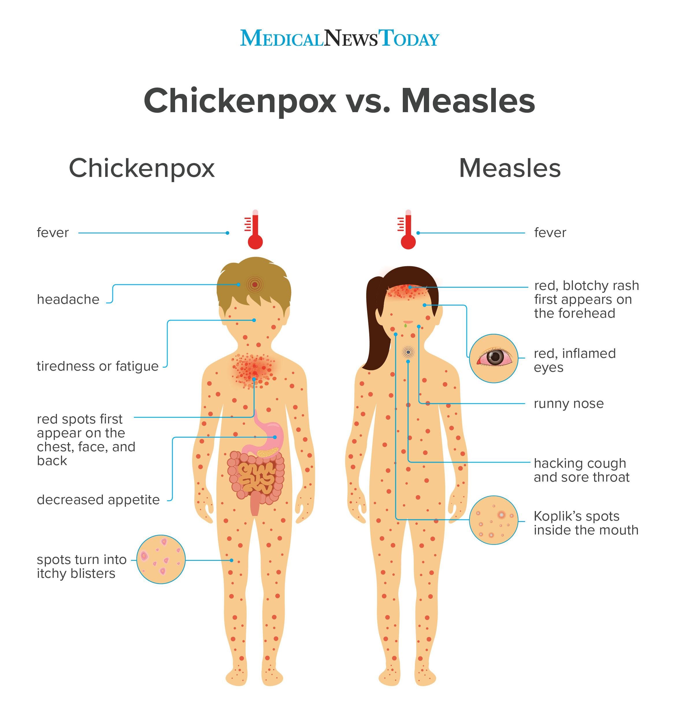 Chickenpox Vs Measles - Maple Leaf Medical Centre, Edgars Road