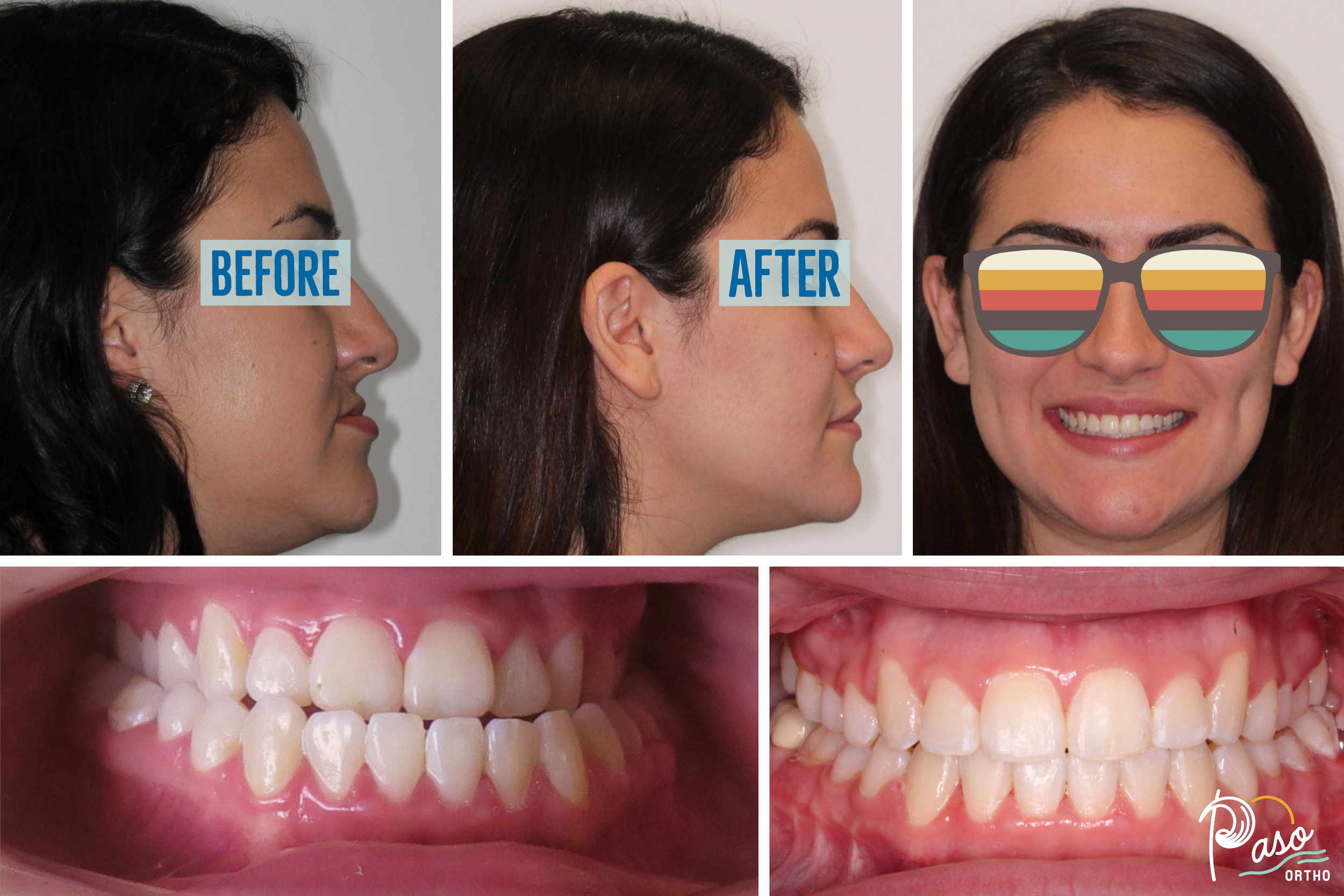 Adult Braces and Jaw Surgery