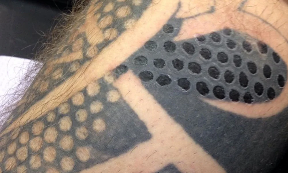 Tatt2Away® Tattoo Removal