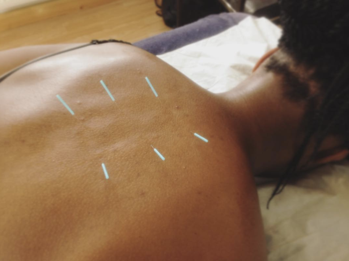 Acupuncture.png