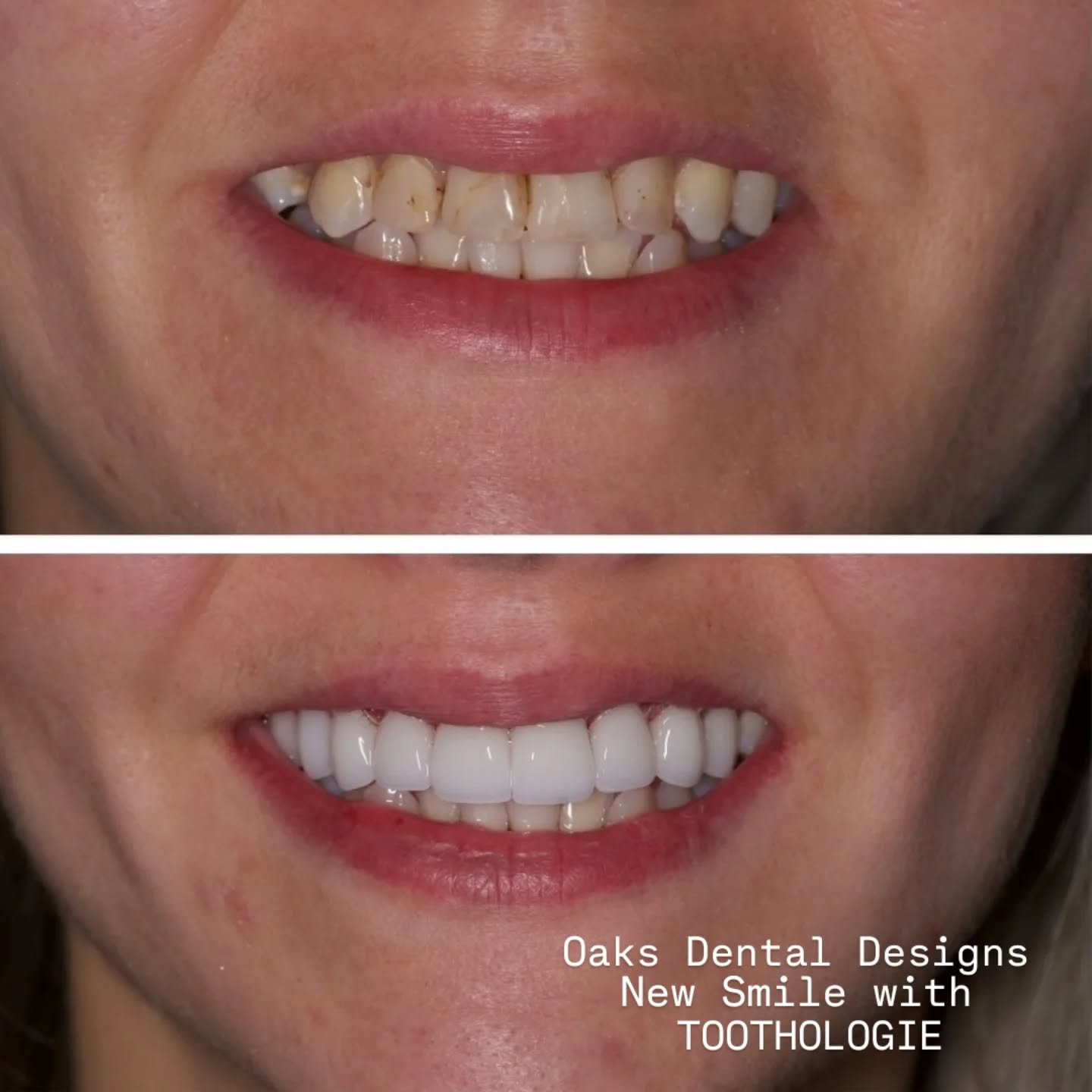 We gave this patient exactly what she was looking for!  I'm so glad to hear and see just how happy she was!

#dentallaboratory #dental #oralhealth #colLABoration #mommieswhomill #makeitemax @ivoclar @ivoclar.na