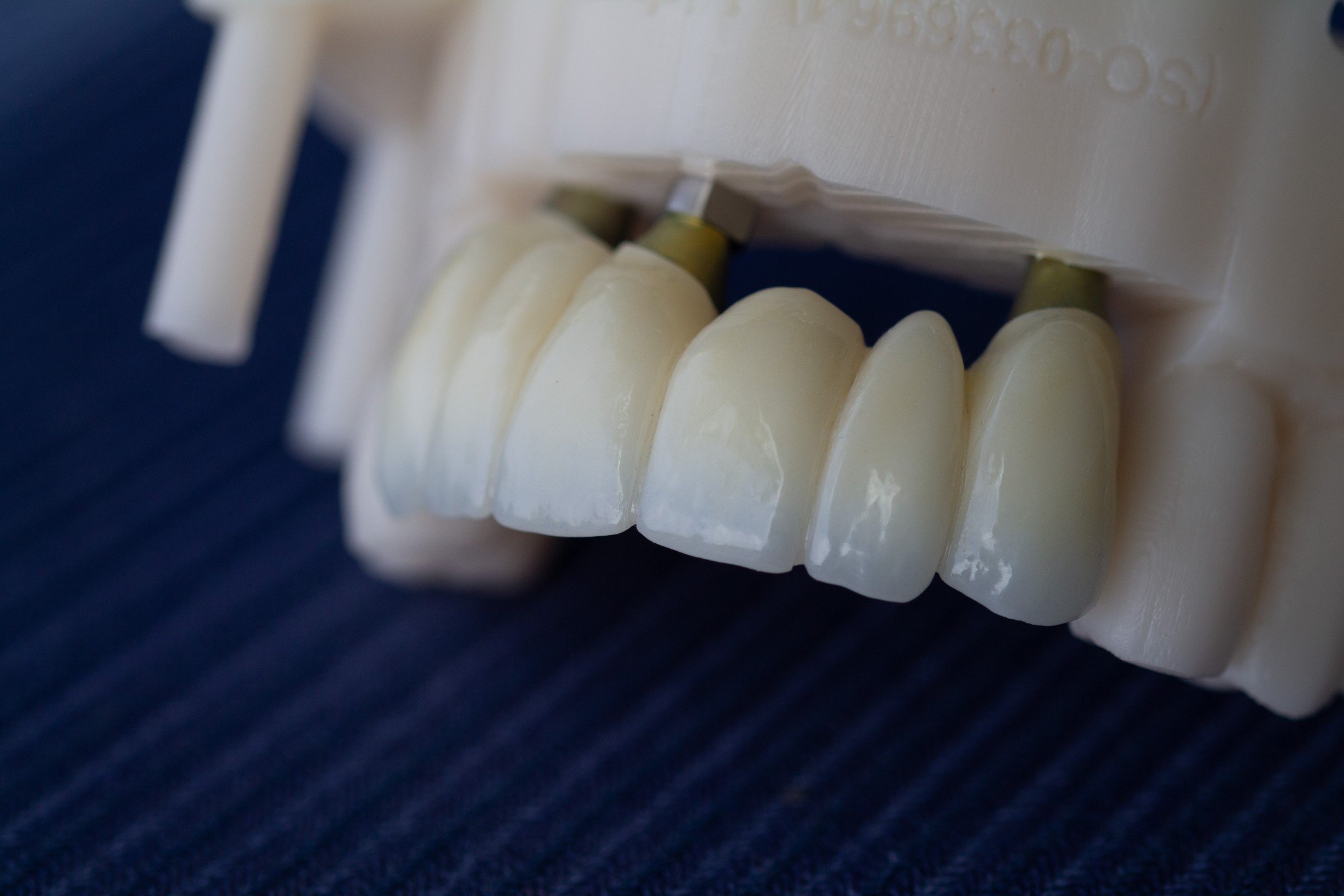 Implant smile for days. 

#Dentalimplant #Newsmile #dentistry #Smilemakeover #dental #oralhealth #dentallab #dentallaboratory #dds #fempreneur #mommieswhomill

@eiront 
@graceolivia.d 
@truabutment - custom abutments @argencorporation - zirconia
@dmg