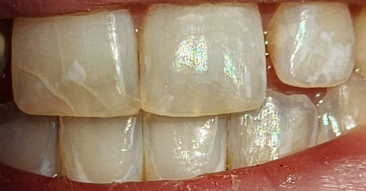 Check out all the small details in these natural teeth. 

This is why we don't just mill a tooth. Send a tooth. 

We want it to match. 

What we get to do is artistry.  From designing how light will reflect off of it, to painting small flecks of whit