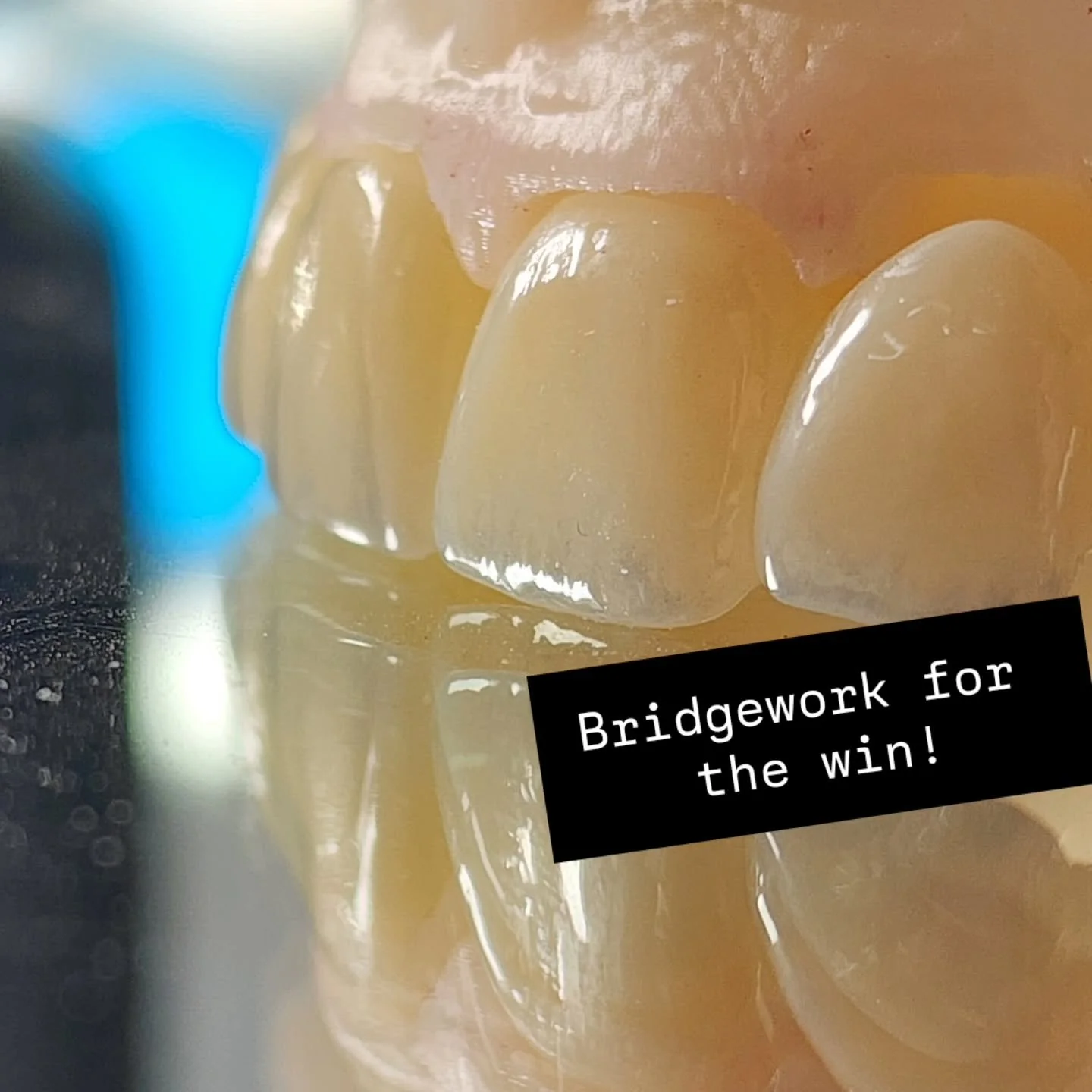 2 bridges to complete a brand new smile for our Alabama patient. 

We absolutely love working with this office they have been clients for years! 

Looking forward to seeing this one finished up amd seated!

#NewSmile #SmileMakeover #MommiesWhoMill #b