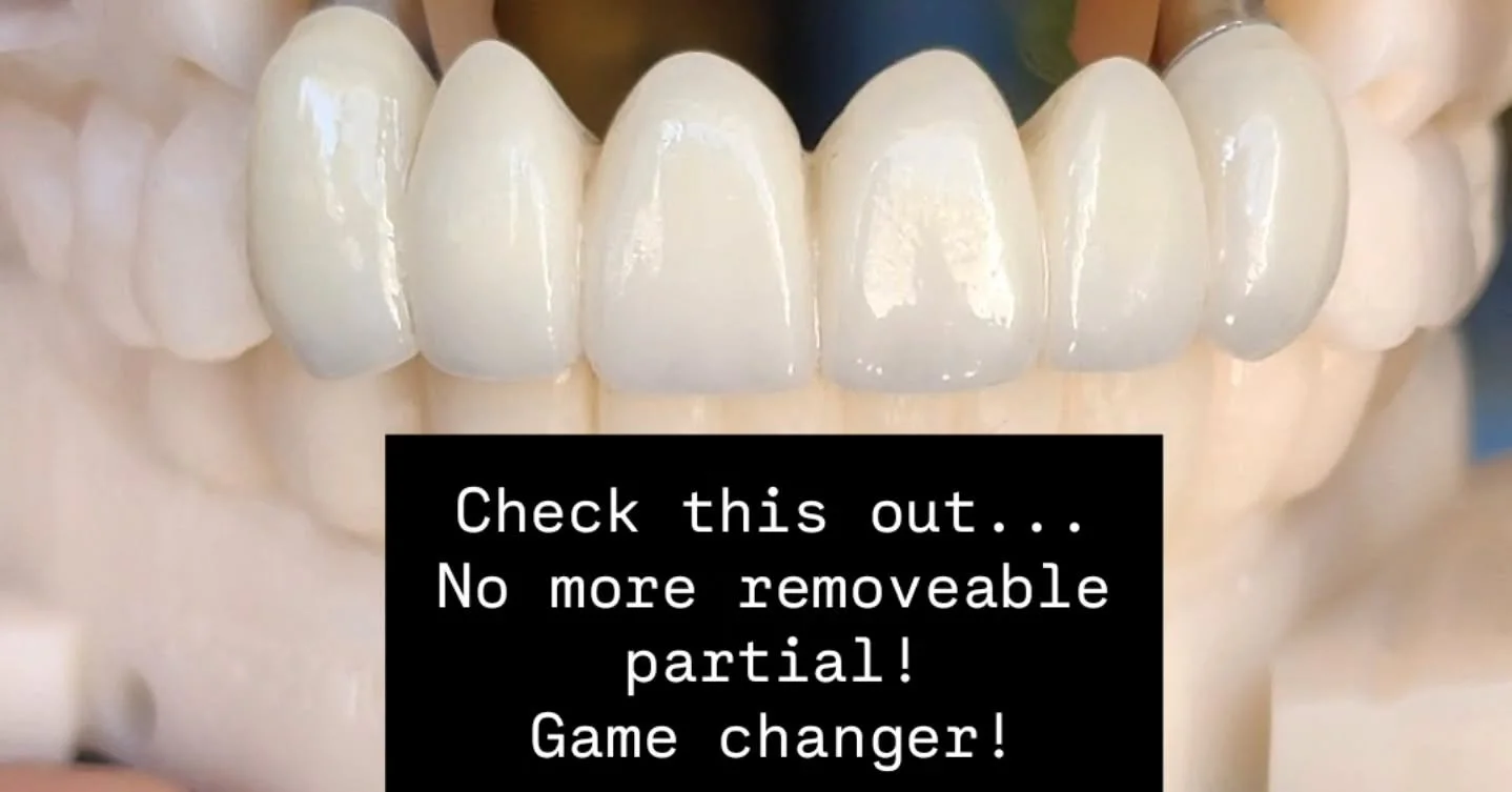 Quality of life! ✔️

Confidence! ✔️

Function! ✔️

Happy Lab. ✔️

Happy Client. ✔️

Happy Patient. ✔️

That's all. 

#dentallab #mommieswhomill  #smilemakeover #dentistry #DentalTechnology