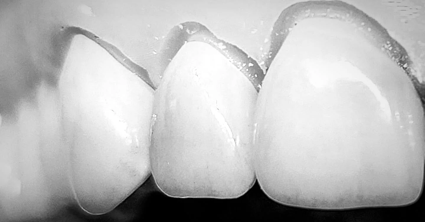 Never quit!  Always keep striving, keep pushing, keep growing.  Small details on the edges of our restorations make them more lifelike.  Make them not look "fake". I remember striving in the early days to make perfect teeth, perfect smiles,