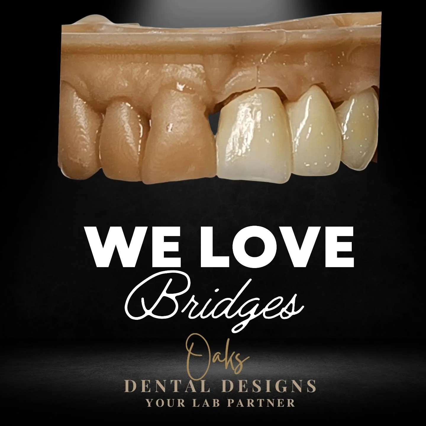 Bridgework is some of our absolute favorite things to do.  We know we are helping a patient restore function and confidence.  Missing teeth cause all kinds of issues.  Knowing we get to give people their smiles back, that's something that makes us pr