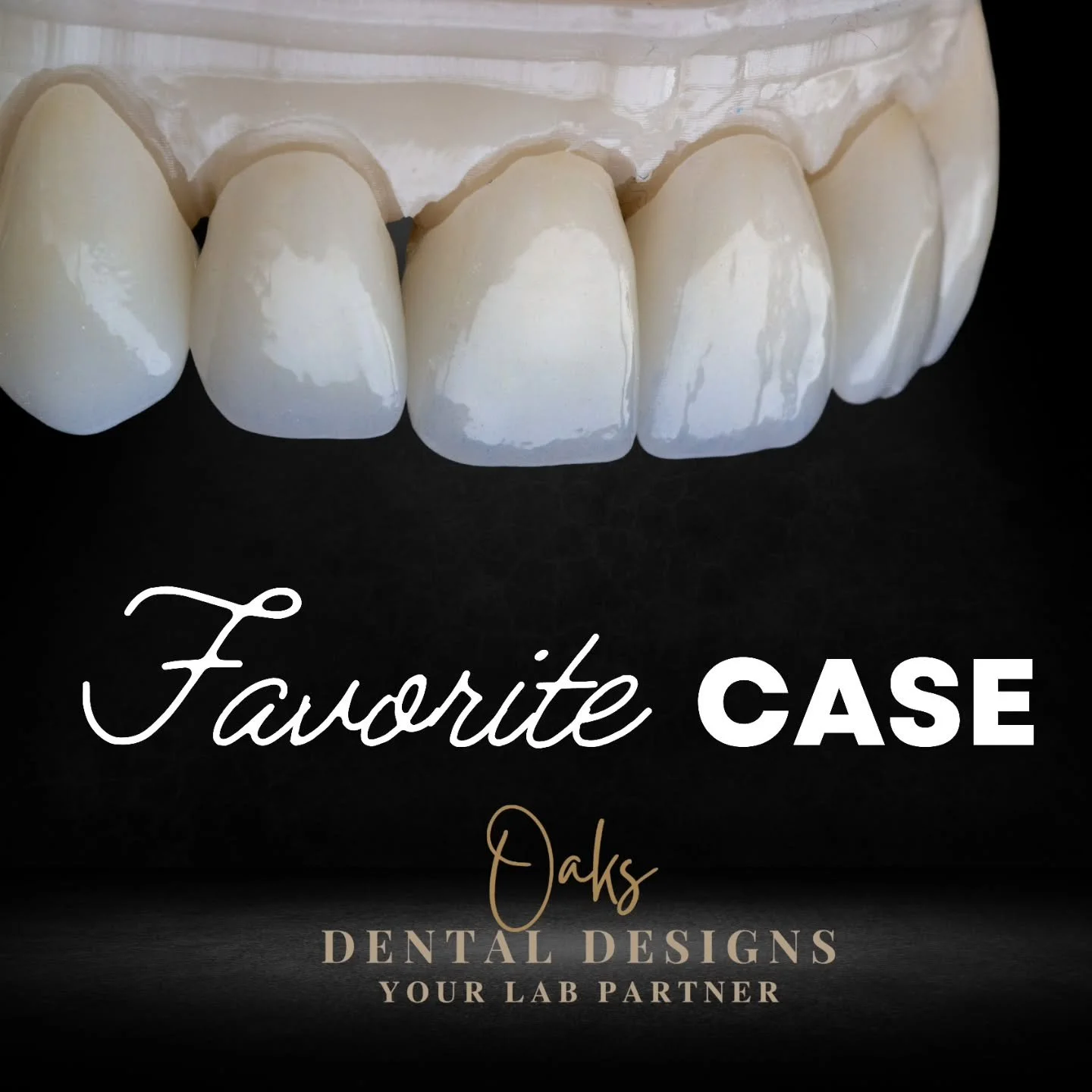 One of the beauties we've delivered.  Loved this case!

#dentalcrowns #newsmile #dentallab #MommiesWhoMill #SmileMakeover