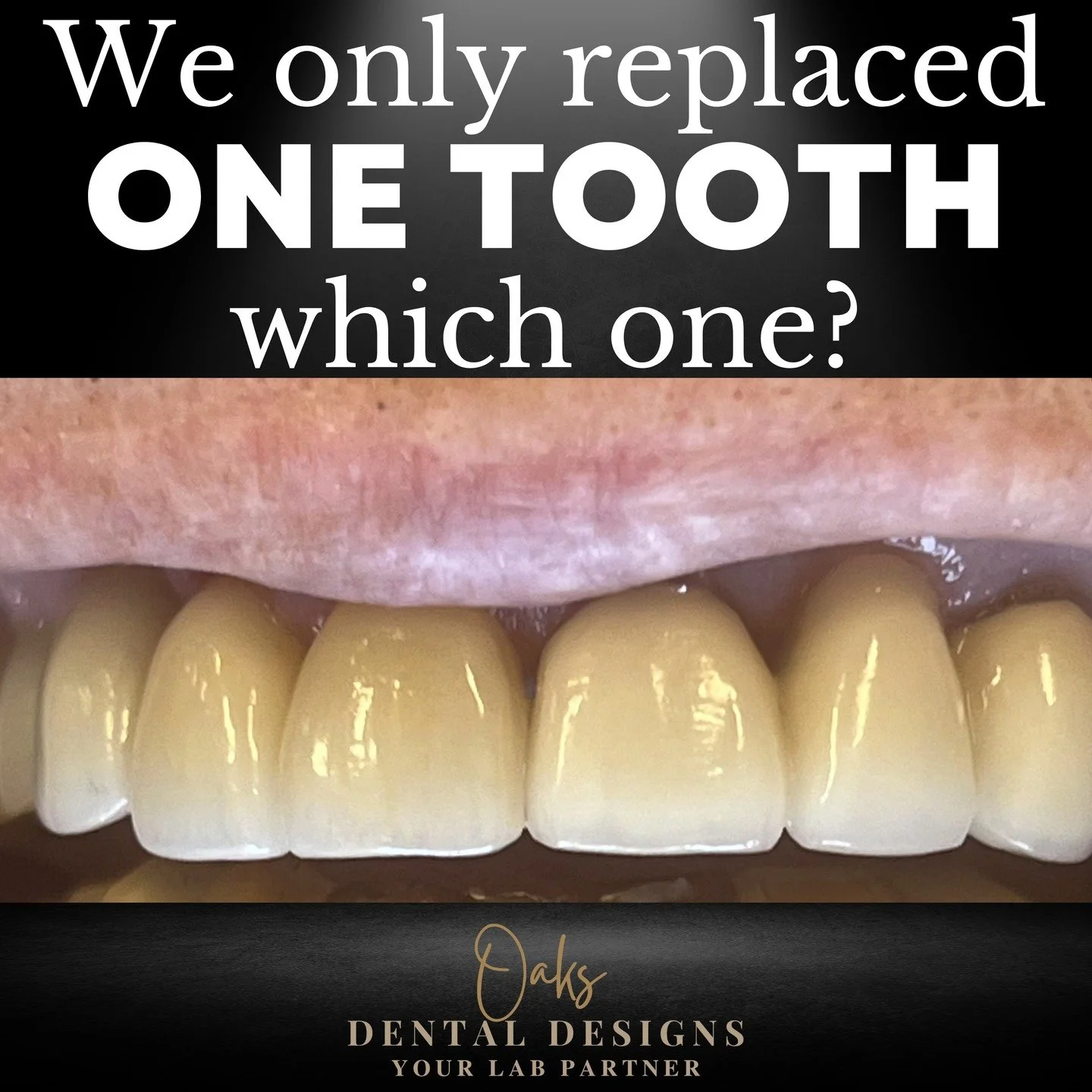 Got this quick phone pic from one of our doctors last week and I had to double check which tooth we did! It blends in so well! We were matching exisitng work done before we started working with this office, so that is always a challenge, but we are t