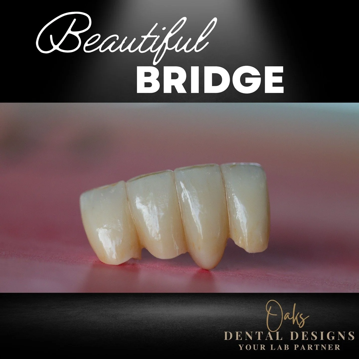 Absolutely love what we do! This bridge will hopefully just disspear when they seat it. We get to restore confidence, function and speech all at the same time with this case! LOVE IT! Getting to work with these teams and doctors all over the country 