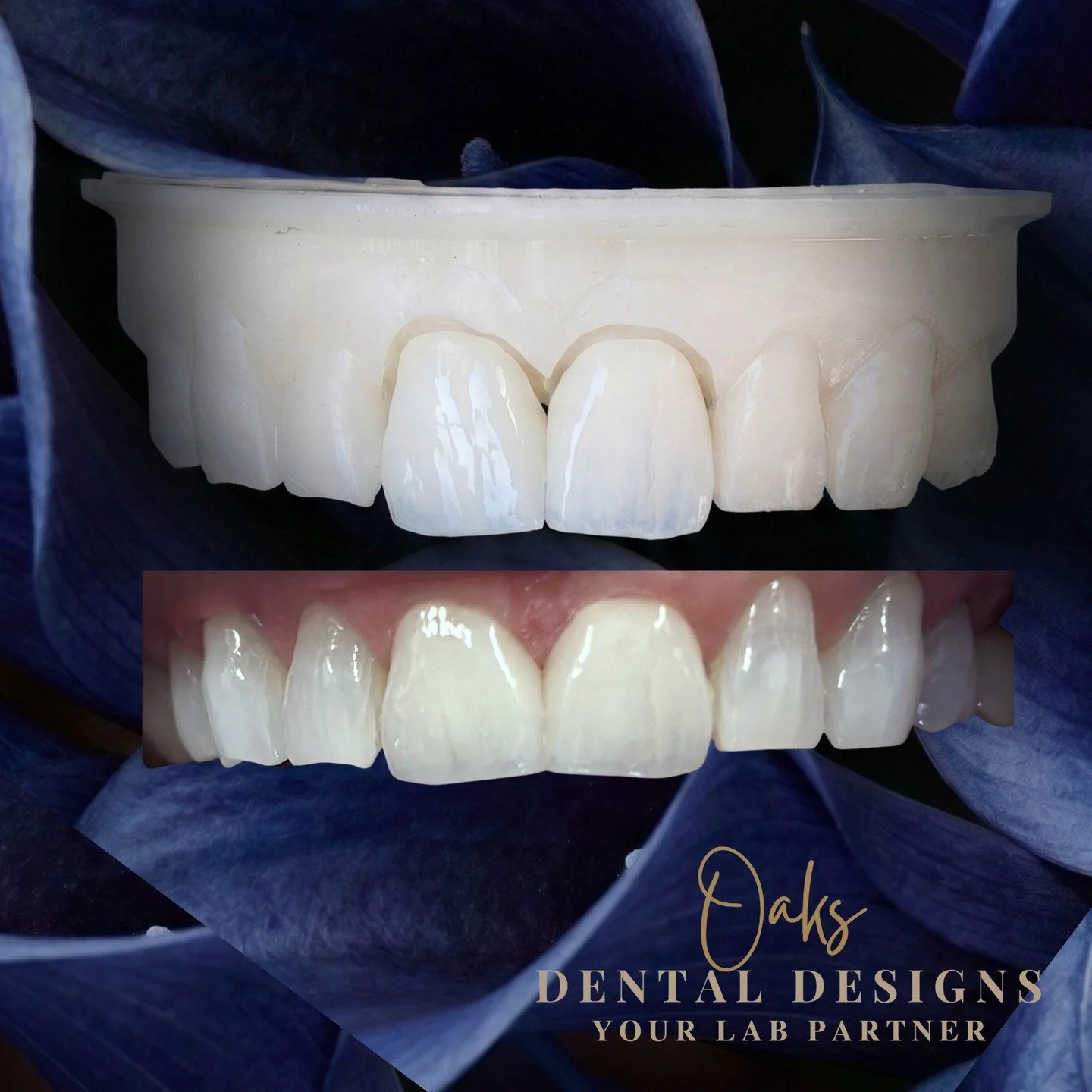 Received a seated picture this moring from our partner doctor! The message I got with it was simply the photo of the seated crowns and this emoji...🔥

We have never seen this patient in person, we are not even in the same state. Most of our clients 