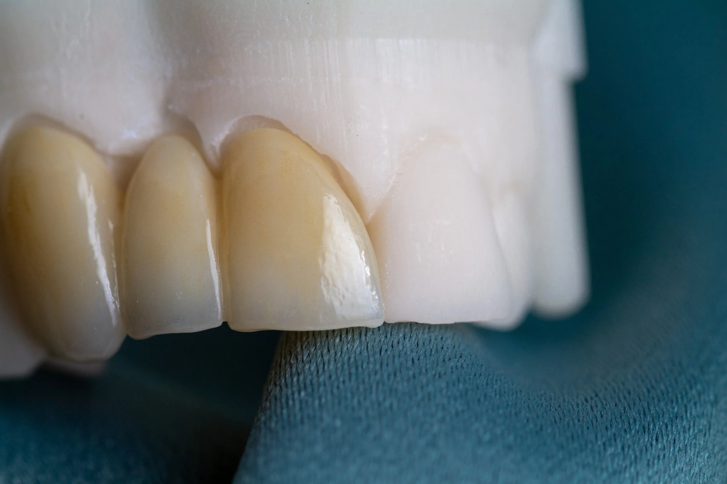 Bridges are such a wonderful option for certain cases. As much as we love implant work, there are times that this option serves the patient more. We love watching the patients smile after they get their smiles restored. 

Working together with office