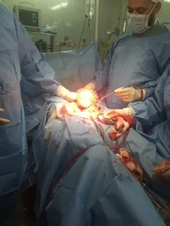 First surgery done souhag” August2017