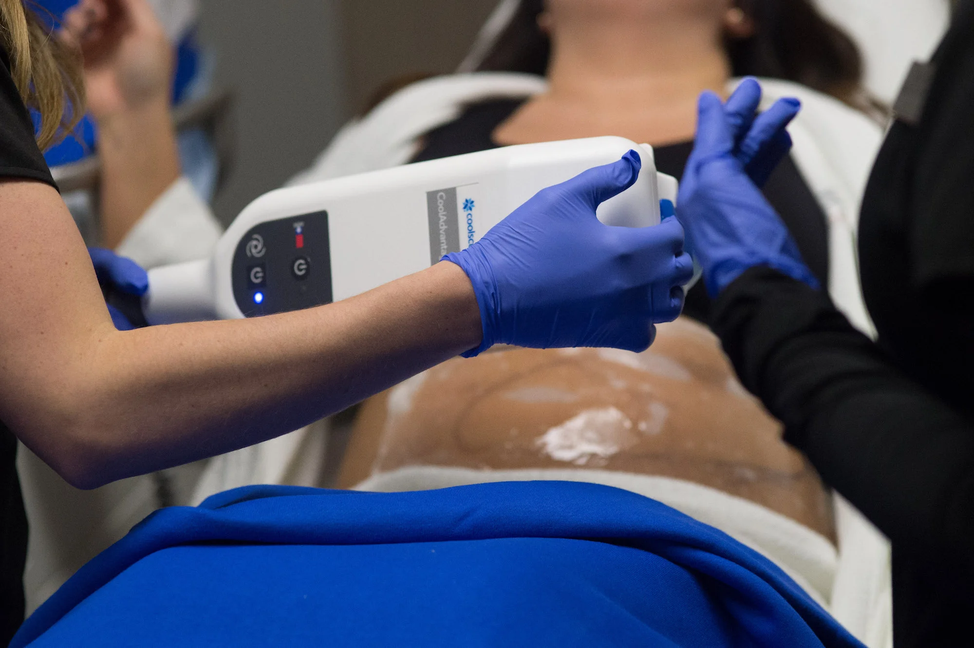 Patient receiving treatment at a Live CoolSculpting Demonstration.