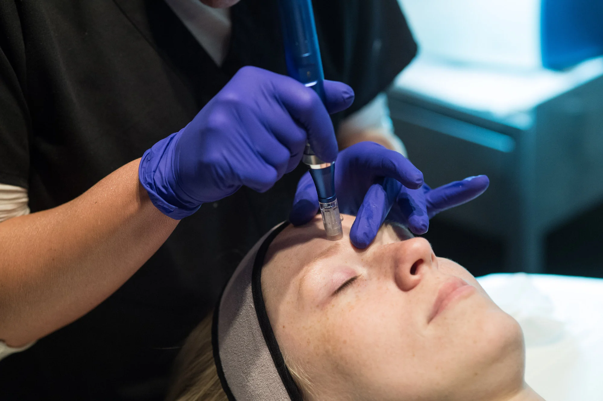 Live Microneedling Demonstration