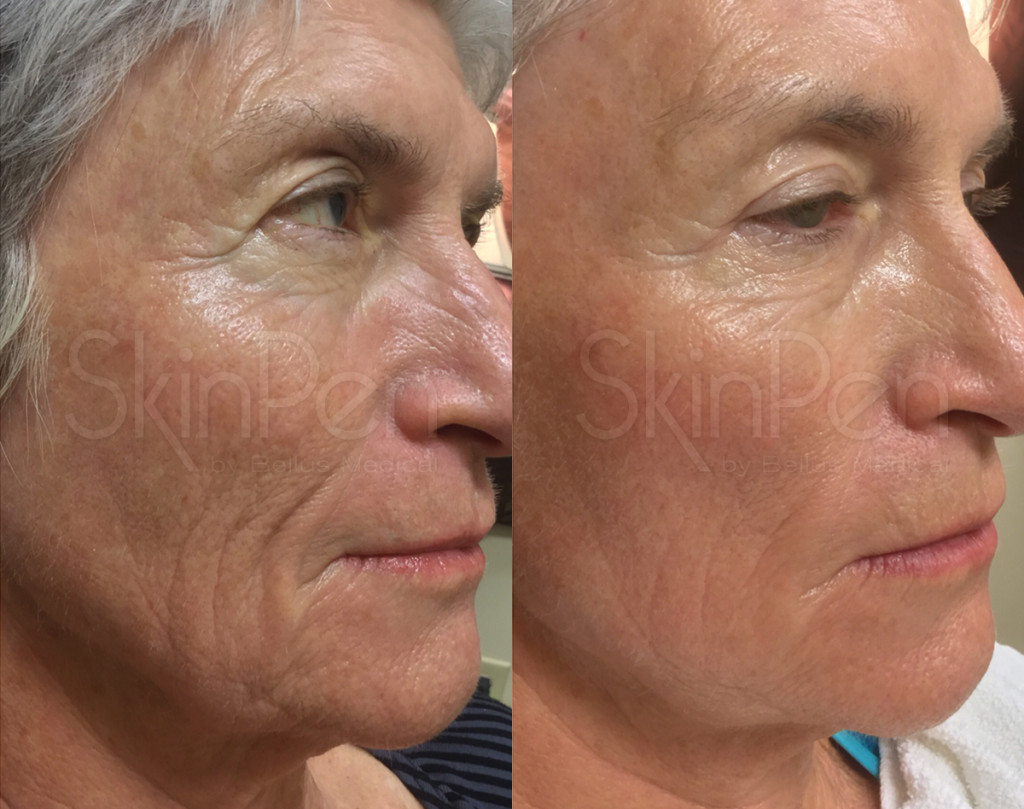 Gender: female / Age: 66 / Treatments: 3 / Frequency: monthly