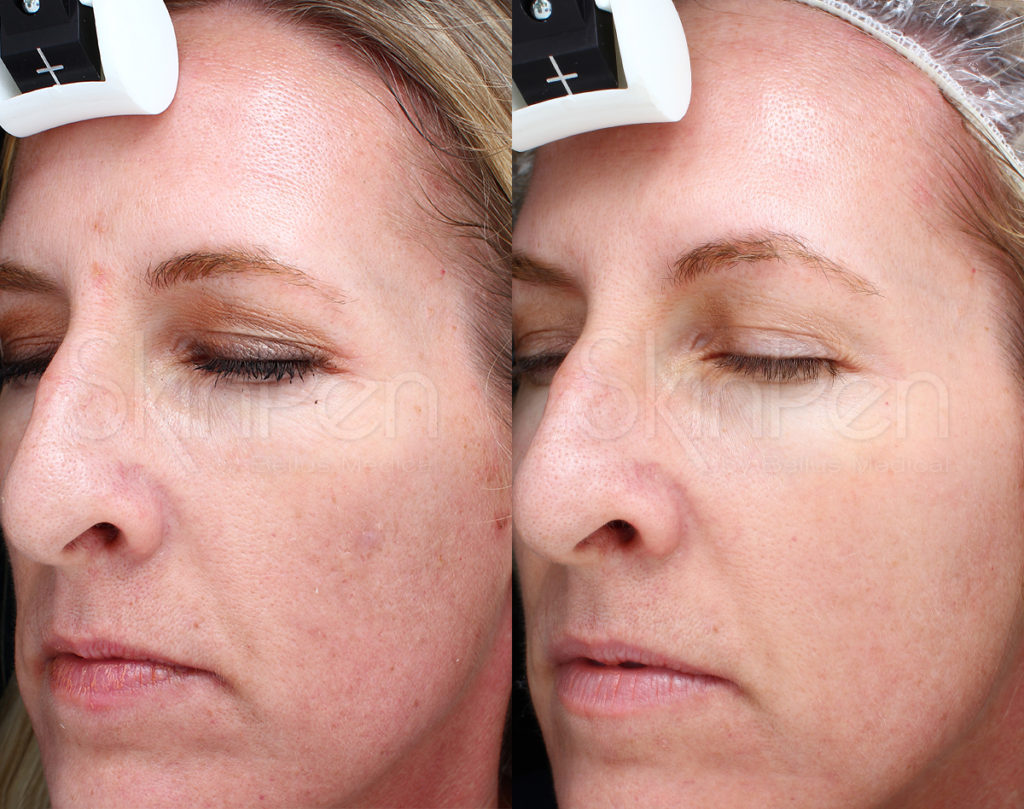 Gender: female / Age: 45 / Treatments: 3 / Frequency: monthly