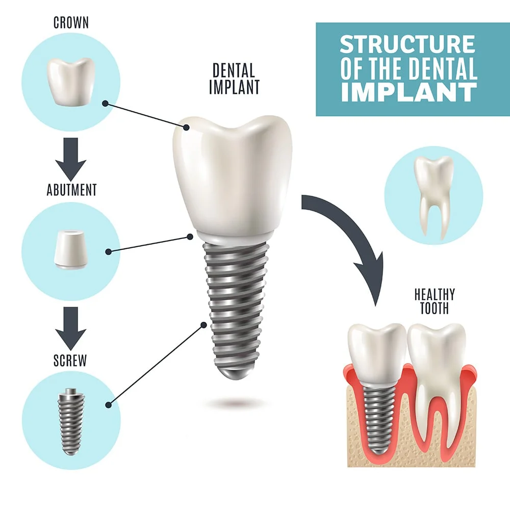 dental-implant-structure.jpg