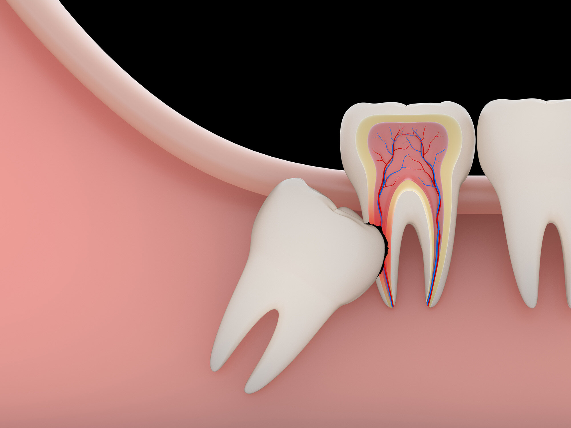 Why Get Impacted Wisdom Teeth Removed If You Feel Fine? Find Out!
