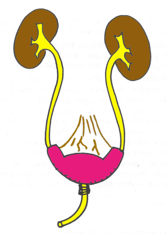 Néovessie ou entérocystoplastie de remplacement