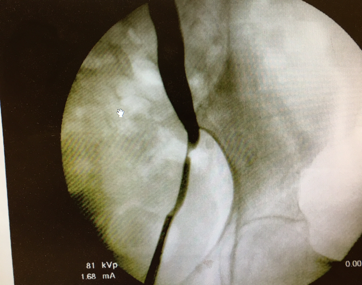 Sténose de l’uretère distal