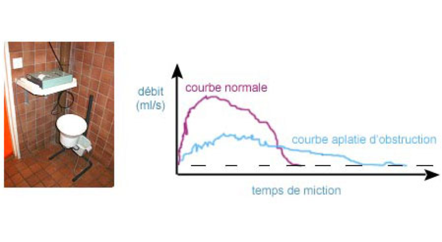 La Rétention Urinaire, une Urgence Chirurgical de la Prostate