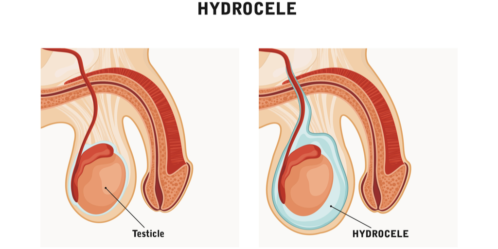 hydrocele.jpg