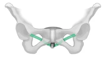 Mise en place d’une bandelette de soutènement sous-urétral©BOSTON SCIENTIFIC CORP