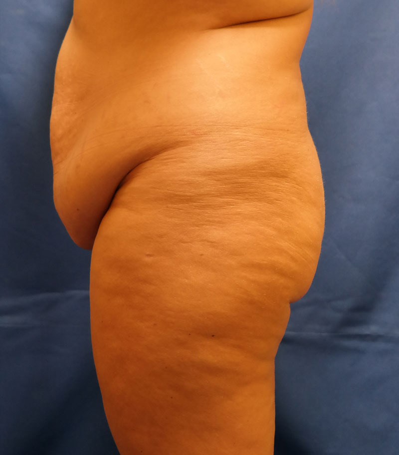 after tummy tuck