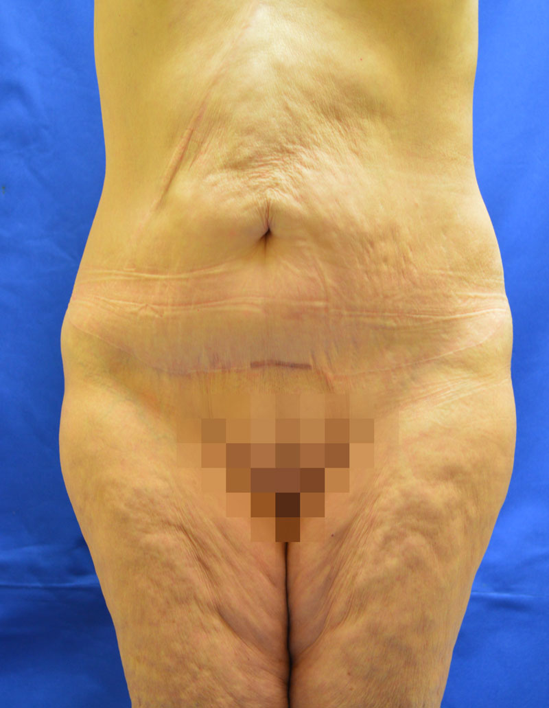 after tummy tuck